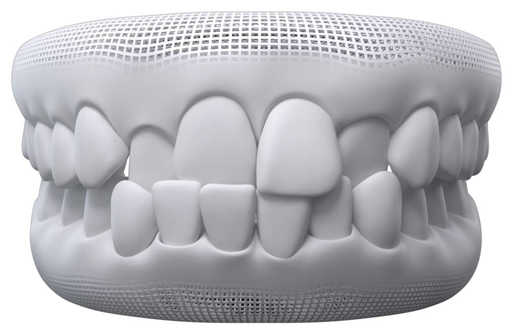 Invisalign Crossbite illustration