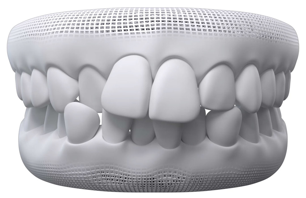 Invisalign Crowded teeth illustration