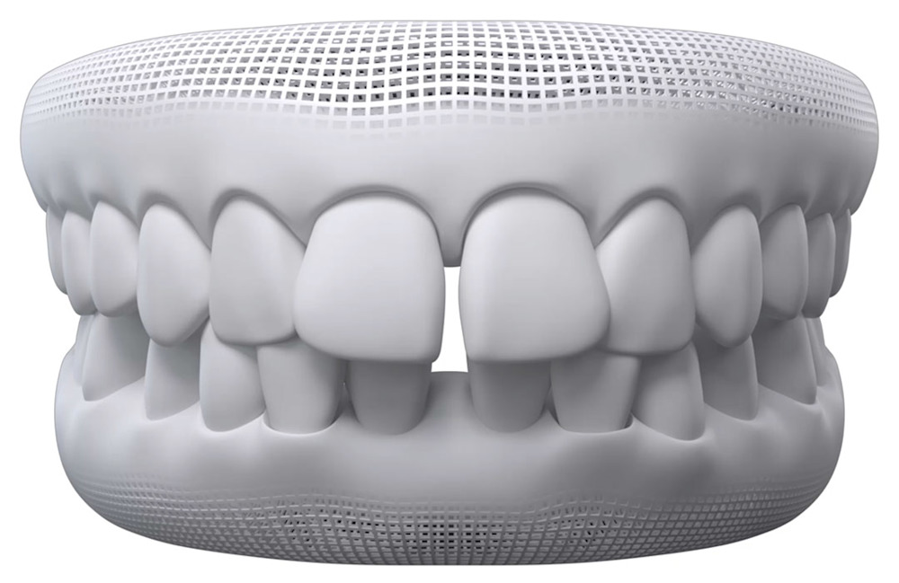 Invisalign Gaps between teeth illustration