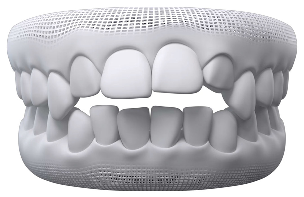 Invisalign Open bite illustration