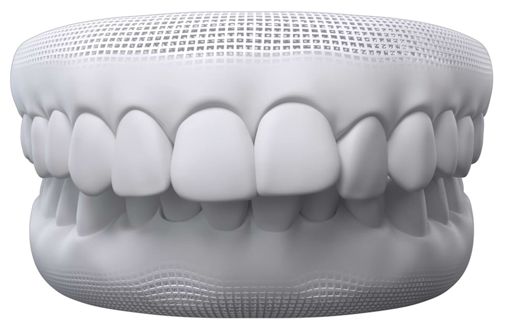 Invisalign Overbite illustration