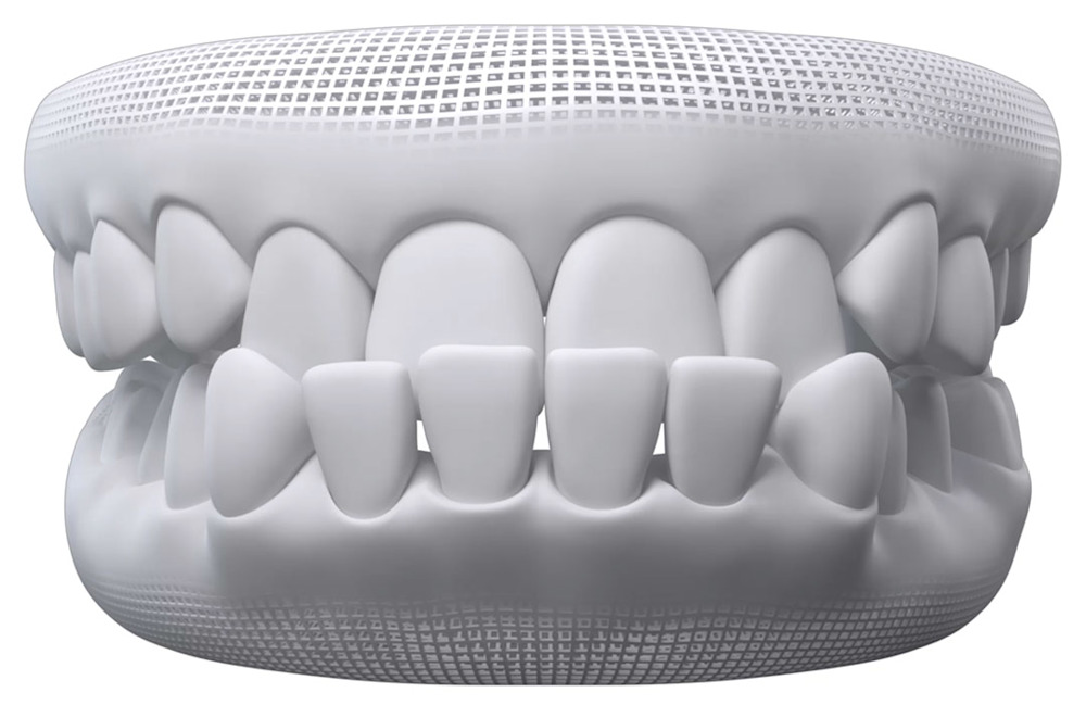 Invisalign Underbite illustration